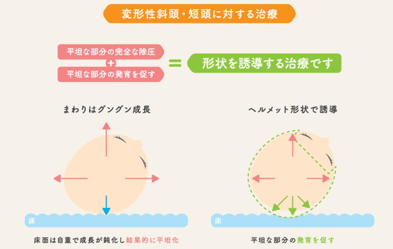 ヘルメット治療とは
