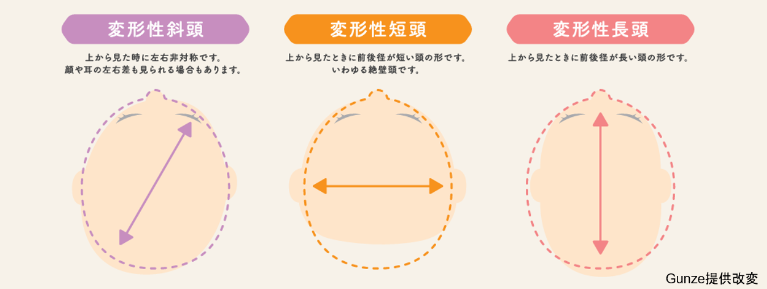 赤ちゃんの頭のかたちの変形